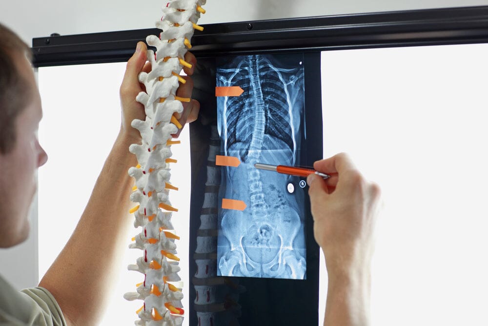 Mild Scoliosis: Is It Serious or Normal? Top Signs to Look For